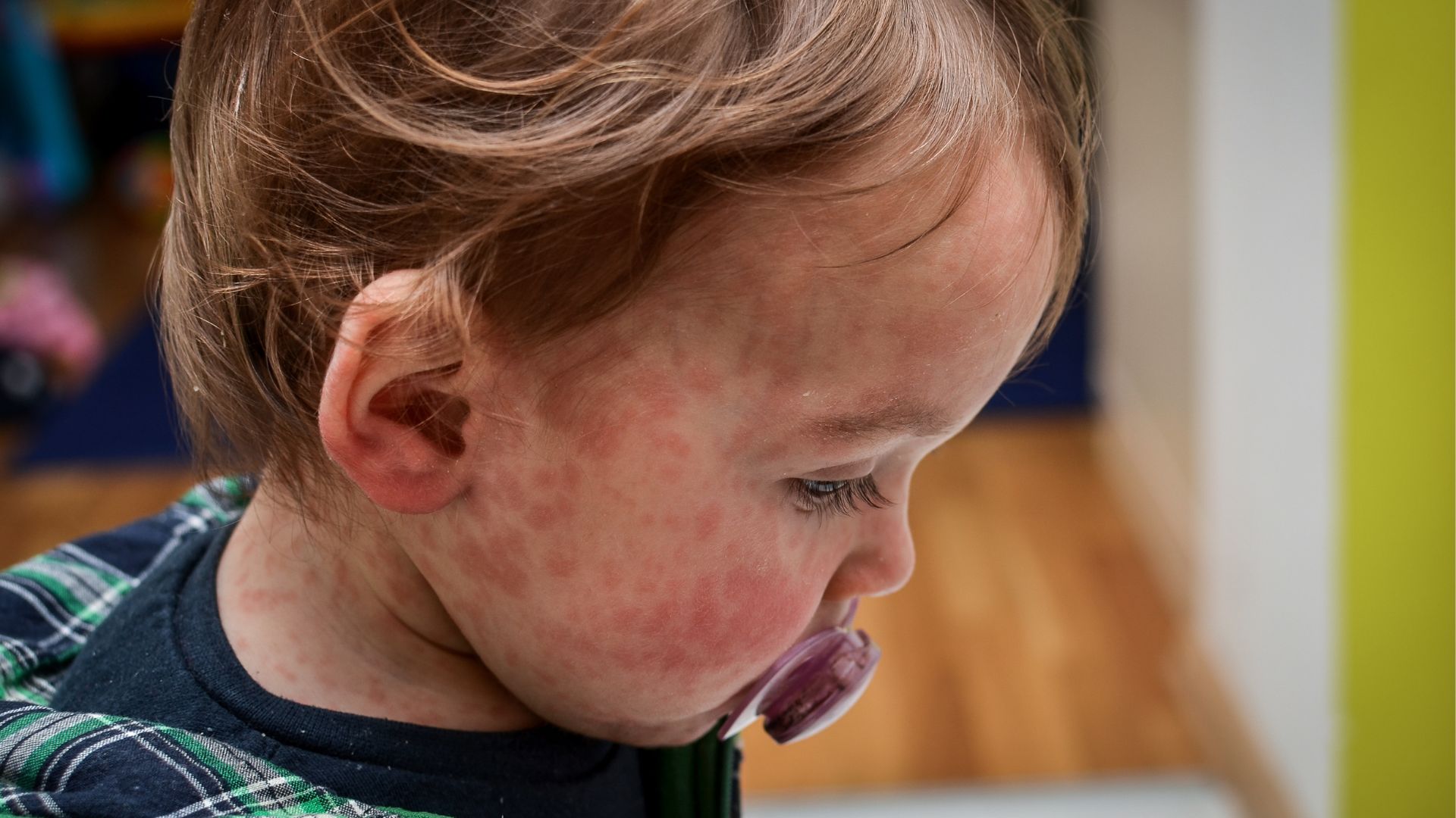 a photo of a child with measles
